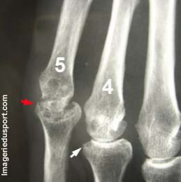 Arthrite rhumatismale et Ulna