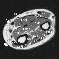 Anatomie du fléchisseur radial du carpe (FCR)