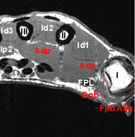 Anatomie du muscle opposant du I