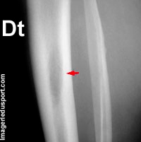 Métastases osseuses